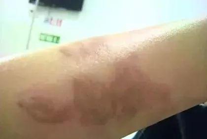 被烫伤敢吃凉瓜吗吗,揭秘饮食恢复之道